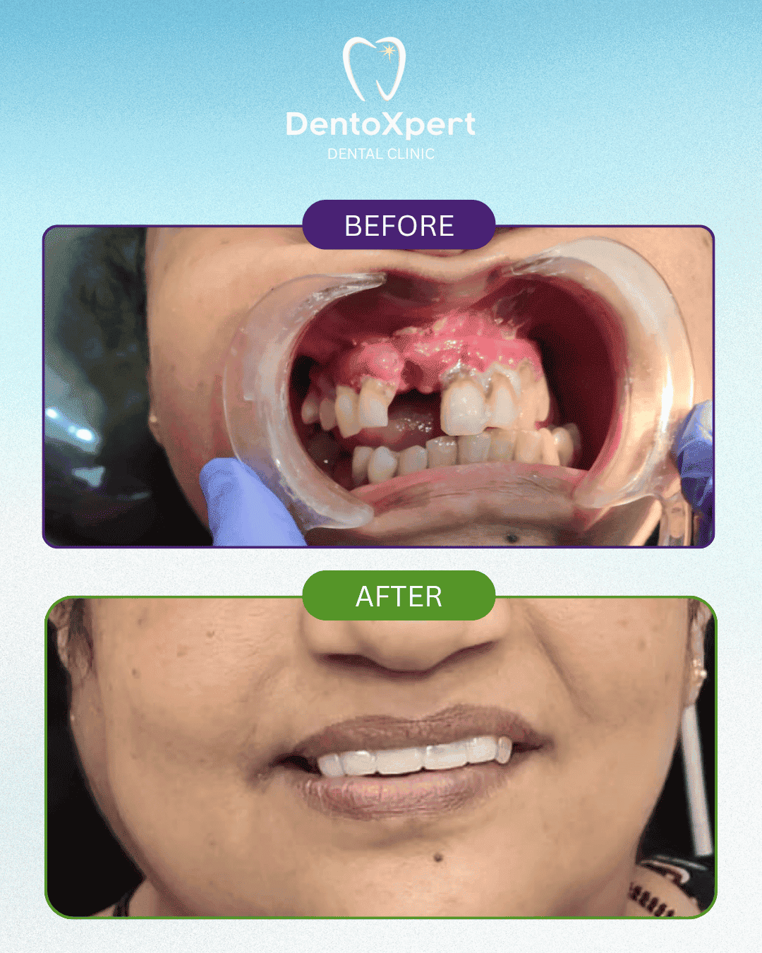 Before and after dental treatment result at DentoXpert Dental Clinic in Thane